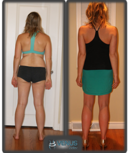 Laura before and after Venus - Back